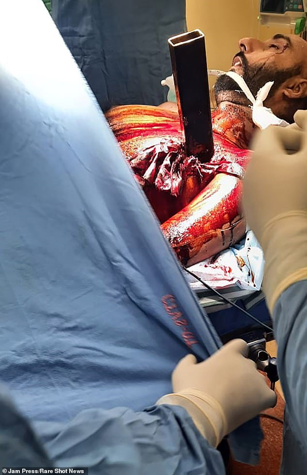 Hardeep was left with a huge hole in his chest after the operation, but doctors managed to successfully remove all of the rod and stop the bleeding