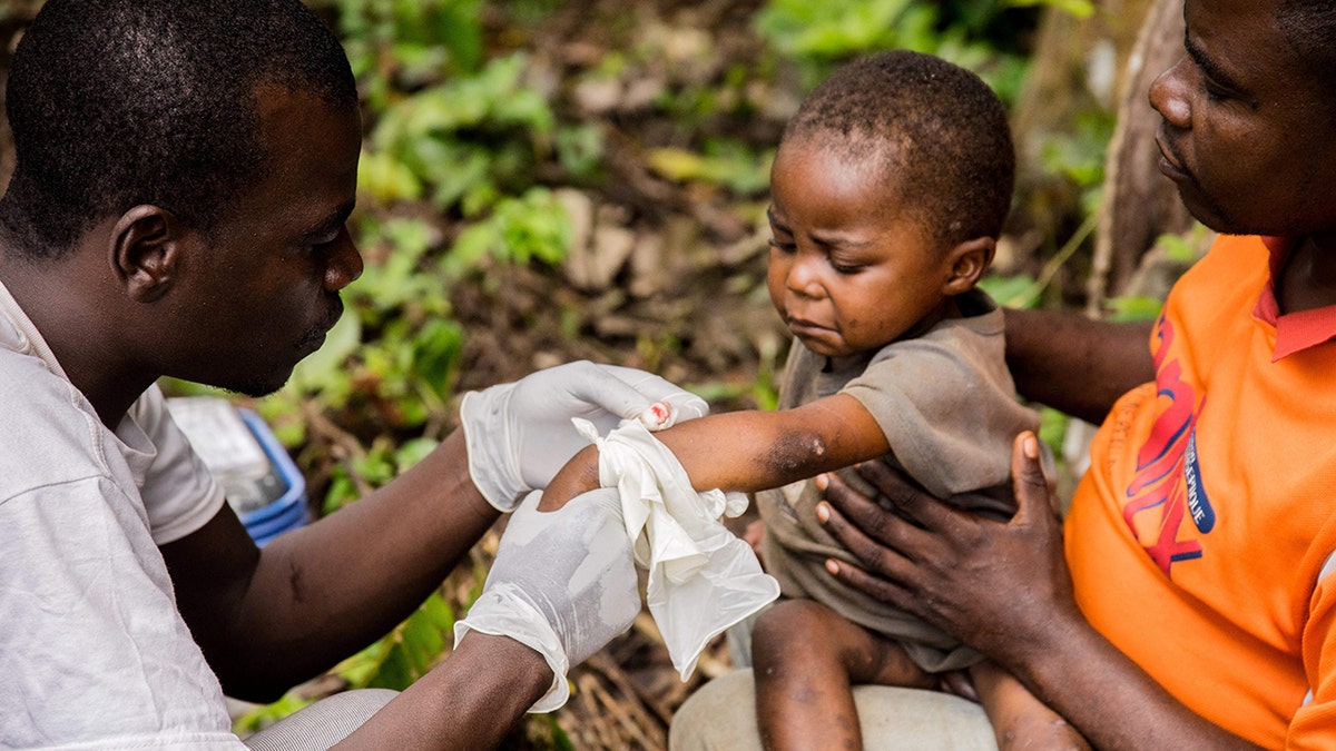 child with monkeypox is treated in africa