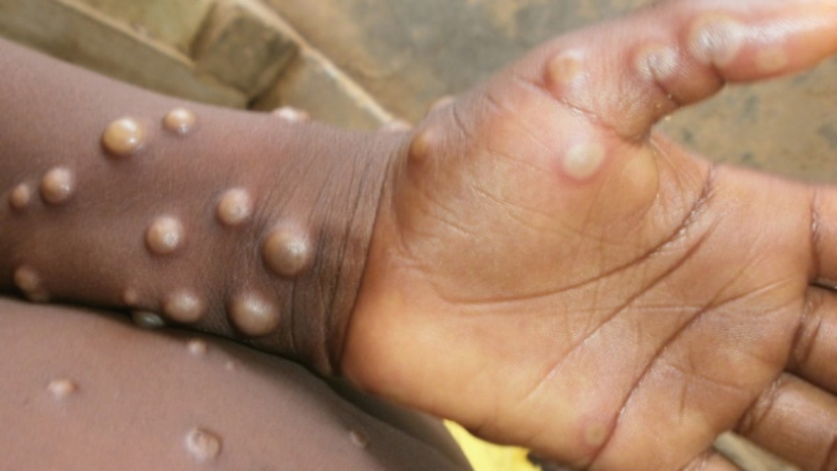 monkeypox child nigeria infection