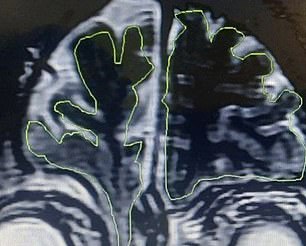 The above shows the encephalocele that has pushed through the patient's skull into his nasal cavity