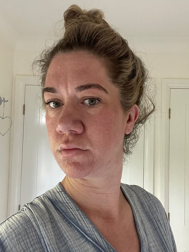 'I was struggling all the time with tiredness. I wasn't sleeping properly. My swollen tongue was also beginning to impede my speech,' Louise says