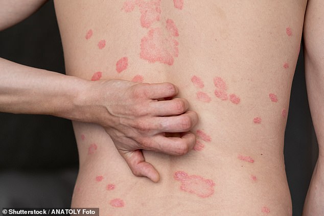 Psoriasis leaves sufferers covered in disfiguring red, scaly patches and affects one in every 50 people in the UK