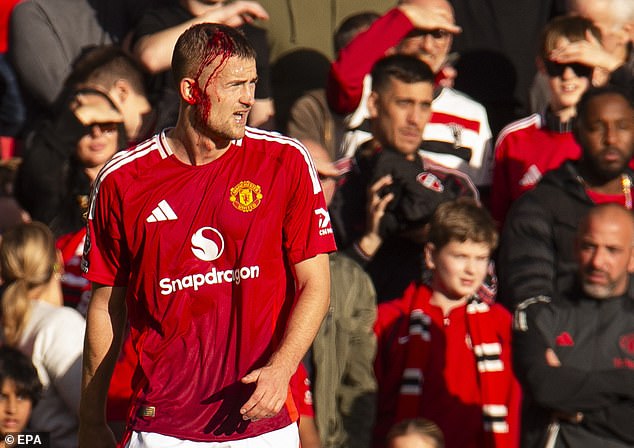 Matthjis de Ligt suffered a nasty head injury early in the game when he collided with the knee of Brentford forward Kevin Schade