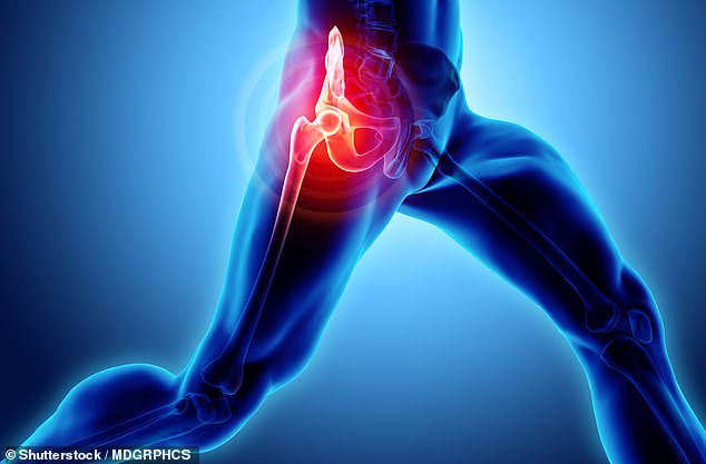 Thousands of Britons undergo hip replacement surgery every year, usually because of significant pain, inflammation and damage to the hip joint