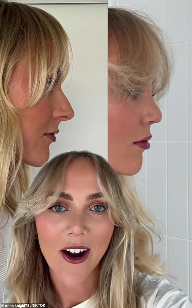 Annie recently shared a video to TikTok showing before and after photos of her nose after undergoing the cosmetic procedure