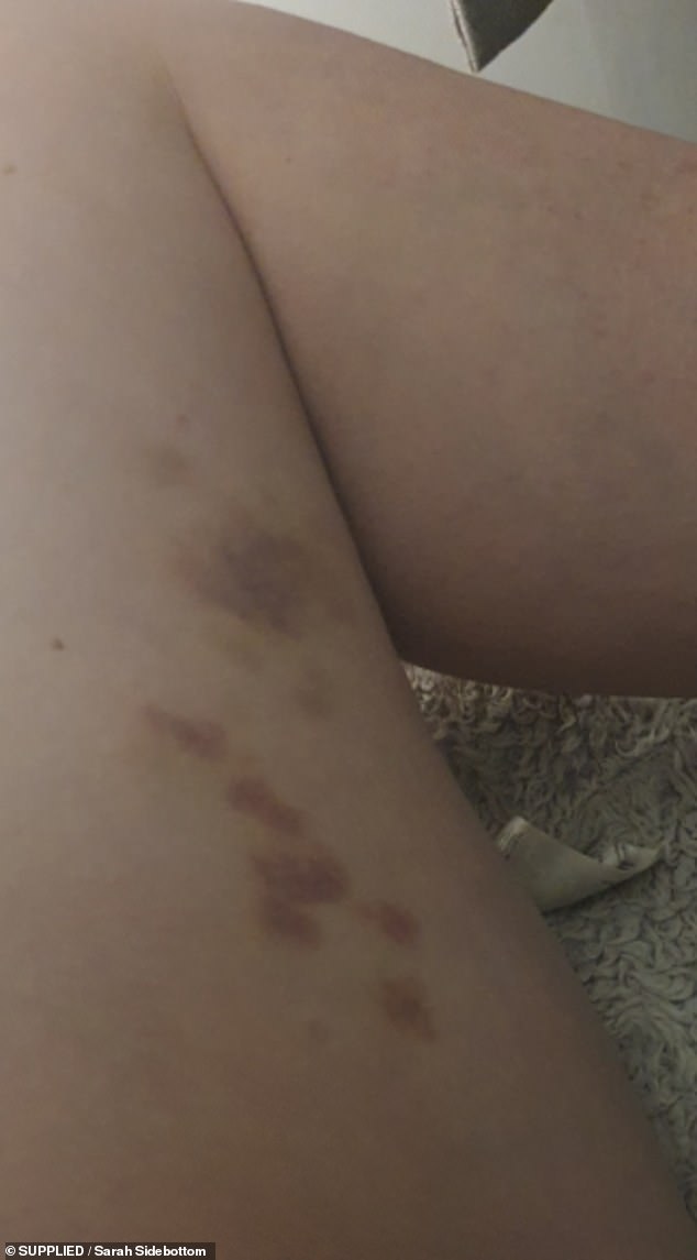 Pictured: the bruises Sarah woke up to on her leg after reliving her childhood trauma through night terrors