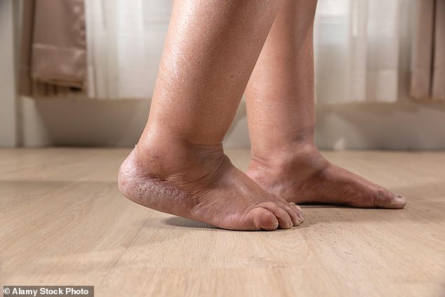 Lipoedema leads to a woman's limbs becoming disproportionately large, even when the rest of the body is slim (file image)