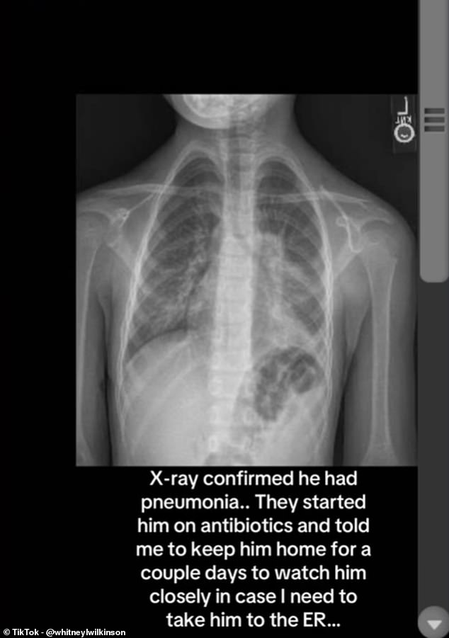 Ms Wilkinson said her son was diagnosed via an X-ray after he spent a week suffering from a cough