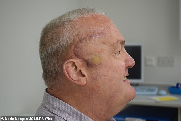 The 62-year-old engineer from Luton, is the first patient to take part in the trial and has seen his tumour shrink by half in a matter of weeks. For the procedure, surgeons removed as much tumour as possible before implanting a small medical device called an Ommaya reservoir under the scalp, which connects to the tumour via a small tube