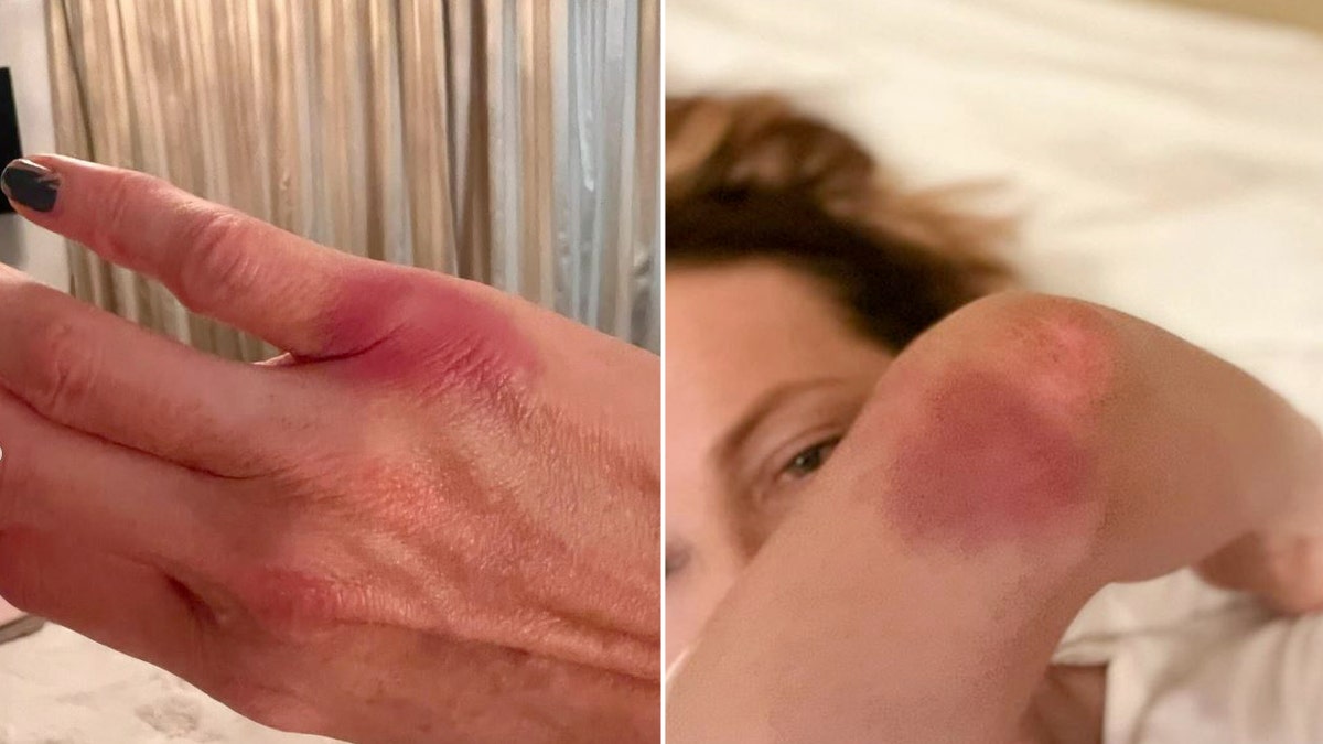 Kate Beckinsale posts pictures of her injured hands and elbow.