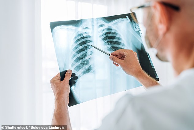 People living in the most deprived parts of England are more likely to develop lung cancer, a study has found (file photo)