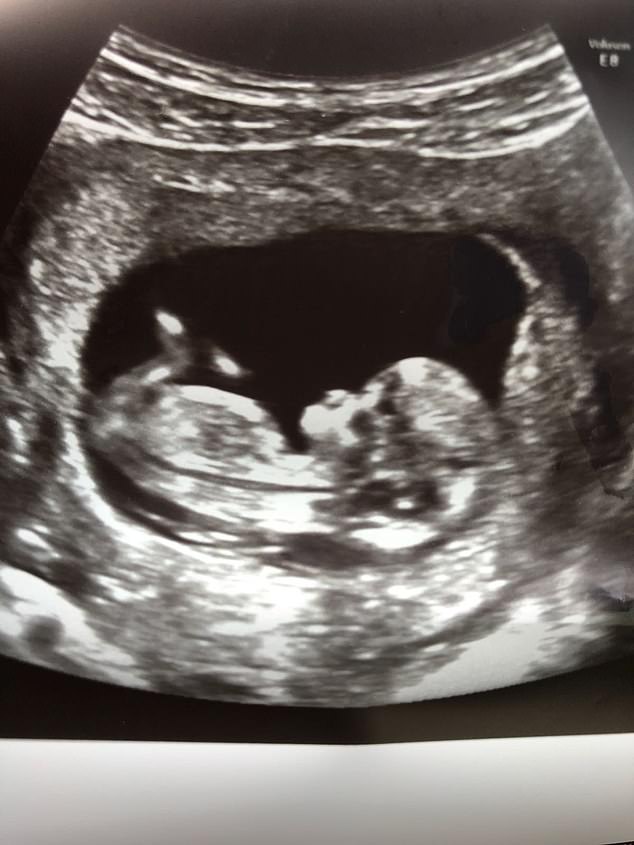 In a twist of fate, one lucky embryo managed to implant and cling on. Consultant after consultant had come to the conclusion that the couple's only option was surrogacy, so it shouldn't have happened - but, thankfully, it did