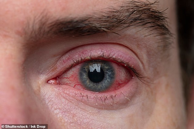 Pink eye is an unpleasant infection that causes irritation, pain, swelling, discharge, and red eyes