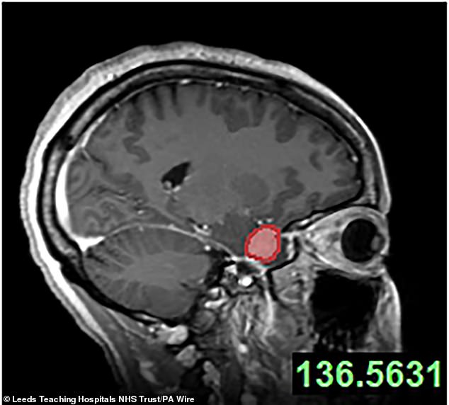 An MRI scan used by surgeons to visualise Ruvimbo Kaviya's tumour