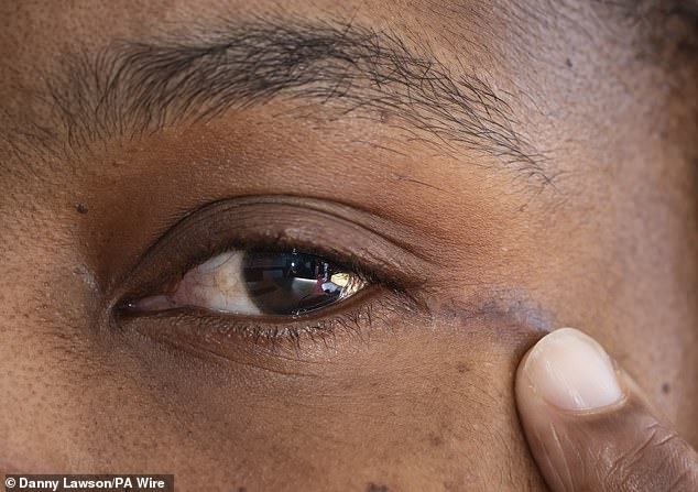 Small scar at the corner of Ruvimbo Kaviya's eye after she received groundbreaking surgery to remove a tumour through her eye socket