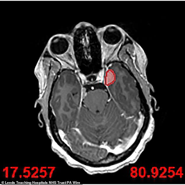 The surgery marks a significant advancement in skull base tumour treatment