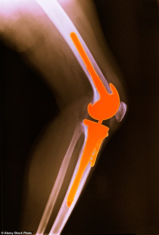 Mr Rasche had knee replacement surgery on one of his knees using the new wafer-like implant that soothes pain before dissolving. Post-operation, he could bend his knee almost immediately. Pictured: File photo of an X-ray showing a total knee replacement