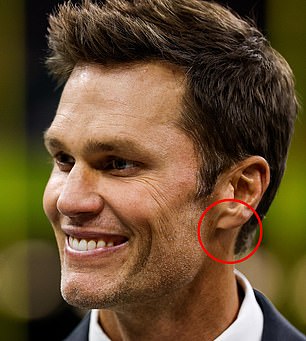 Brady is pictured at right during the Super Bowl. Plastic surgeons told DailyMail.com potential scarring near his ear could indicate a face lift