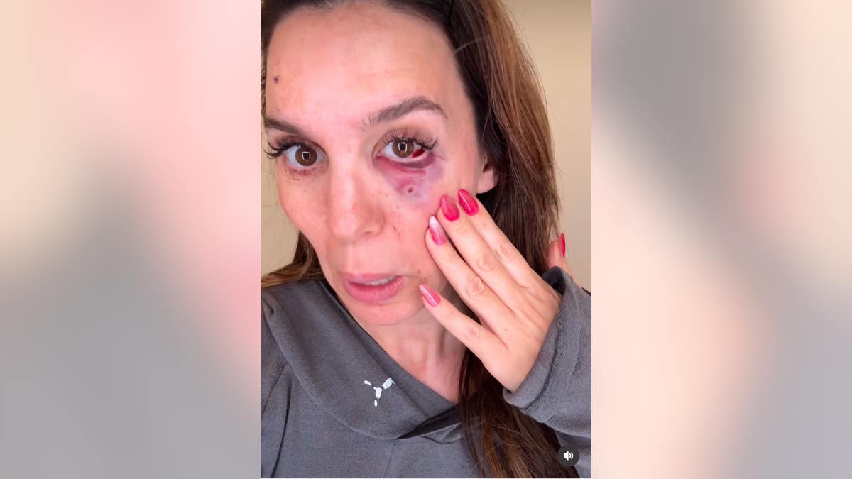 christy carlson romano showing eye injury